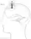 Fig. 04 - Expandable and collapsible brain cannula