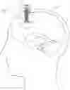 Fig. 05 - Expandable and collapsible brain cannula