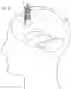 Fig. 08 - Expandable and collapsible brain cannula