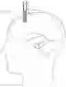 Fig. 09 - Expandable and collapsible brain cannula