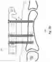 Fig. 05 - DYNAMIC EXTERNAL FIXATOR SYSTEM FOR SMALL JOINTS