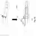 Fig. 12 - DYNAMIC EXTERNAL FIXATOR SYSTEM FOR SMALL JOINTS