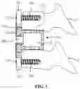 Fig. 02 - Spinal fixation device