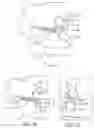 Fig. 05 - Lateral mass fixation implant