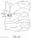 Fig. 19 - Lateral mass fixation implant