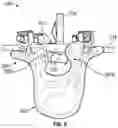 Fig. 07 - SYSTEMS AND METHODS FOR A SPINAL IMPLANT