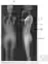 Fig. 02 - Surgery planning tool for spinal correction rod