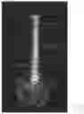 Fig. 03 - Surgery planning tool for spinal correction rod