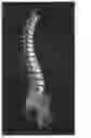 Fig. 04 - Surgery planning tool for spinal correction rod