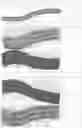 Fig. 07 - Surgery planning tool for spinal correction rod