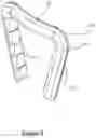 Fig. 09 - Staple and plate hard tissue fixation