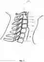 Fig. 02 - ALL-IN-ONE ODONTOID FIXATION GUIDE APPARATUS, SYSTEMS, AND METHODS