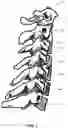 Fig. 03 - ALL-IN-ONE ODONTOID FIXATION GUIDE APPARATUS, SYSTEMS, AND METHODS