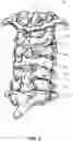 Fig. 04 - ALL-IN-ONE ODONTOID FIXATION GUIDE APPARATUS, SYSTEMS, AND METHODS