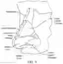 Fig. 02 - Methods and devices to treat nasal airways