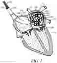 Fig. 02 - Medical device for use in bodily lumens, for example an atrium