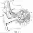 Fig. 02 - Semiautomated robotic cochlear implant surgery