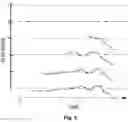 Fig. 07 - Semiautomated robotic cochlear implant surgery