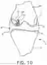 Fig. 10 - System and technique for accessing extra articular lesions or abnormalities or intra osseous lesions or bone marrow lesions