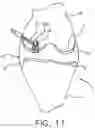 Fig. 11 - System and technique for accessing extra articular lesions or abnormalities or intra osseous lesions or bone marrow lesions