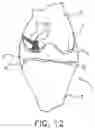 Fig. 12 - System and technique for accessing extra articular lesions or abnormalities or intra osseous lesions or bone marrow lesions