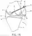 Fig. 16 - System and technique for accessing extra articular lesions or abnormalities or intra osseous lesions or bone marrow lesions