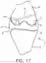 Fig. 17 - System and technique for accessing extra articular lesions or abnormalities or intra osseous lesions or bone marrow lesions