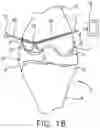 Fig. 18 - System and technique for accessing extra articular lesions or abnormalities or intra osseous lesions or bone marrow lesions