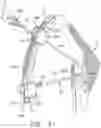 Fig. 31 - System and technique for accessing extra articular lesions or abnormalities or intra osseous lesions or bone marrow lesions