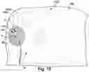 Fig. 10 - Apparatus and method for helping to protect a patient#s hair