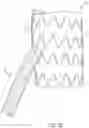 Fig. 03 - Endovascular systems, devices, and methods allowing for branch device placement in channel of main graft