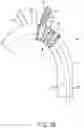 Fig. 04 - Endovascular systems, devices, and methods allowing for branch device placement in channel of main graft