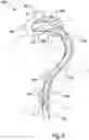 Fig. 08 - Stent-graft prosthesis, system and method for improved delivery of a stent-graft prosthesis