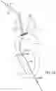 Fig. 18 - SYSTEMS AND METHODS FOR TRANSCATHETER AORTIC VALVE TREATMENT