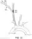 Fig. 08 - SYSTEMS AND METHODS FOR TRANSCATHETER AORTIC VALVE TREATMENT