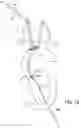 Fig. 18 - SYSTEMS AND METHODS FOR TRANSCATHETER AORTIC VALVE TREATMENT