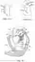 Fig. 04 - Prosthetic heart valve devices and associated systems and methods