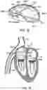 Fig. 05 - Prosthetic heart valve devices and associated systems and methods