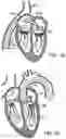 Fig. 06 - Prosthetic heart valve devices and associated systems and methods
