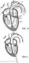 Fig. 07 - Prosthetic heart valve devices and associated systems and methods