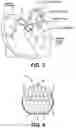 Fig. 04 - DEVICES, SYSTEMS AND METHODS FOR COLLAPSIBLE AND EXPANDABLE IMPLANT LOADING, TRANSSEPTAL DELIVERY, POSITIONING DEPLOYMENT AND REPOSITIONING DEPLOYMENT
