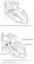 Fig. 04 - Adjustable artificial chordae tendineae fixing assembly and an implanting method thereof