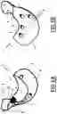 Fig. 02 - Bone prosthesis and method for its placement