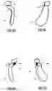 Fig. 03 - Bone prosthesis and method for its placement