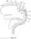 Fig. 08 - Directional stent for accessing extravascular spaces
