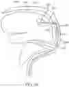 Fig. 09 - Directional stent for accessing extravascular spaces