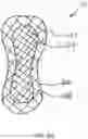 Fig. 27 - Method of manufacturing an ankle foot orthosis