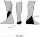 Fig. 45 - Method of manufacturing an ankle foot orthosis