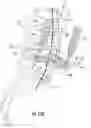 Fig. 15 - Distractive and mobility-enabling lumbar spinal orthosis devices, systems, and methods for treating mechanical low back pain