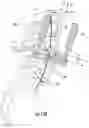 Fig. 16 - Distractive and mobility-enabling lumbar spinal orthosis devices, systems, and methods for treating mechanical low back pain
